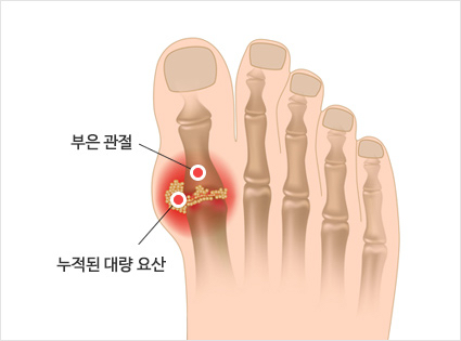 마운자로 통풍 9가지 핵심 정리|요산 수치 오를까, 내려갈까? 2 image 3